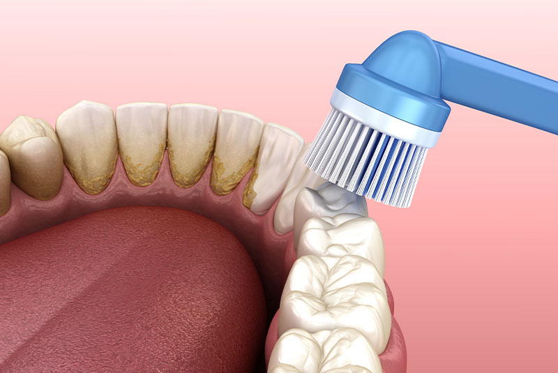 dental cleaning graphic