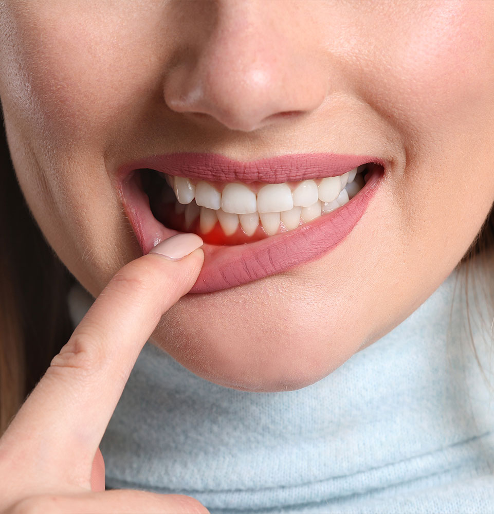 close up of patient showing off their gums while smiling