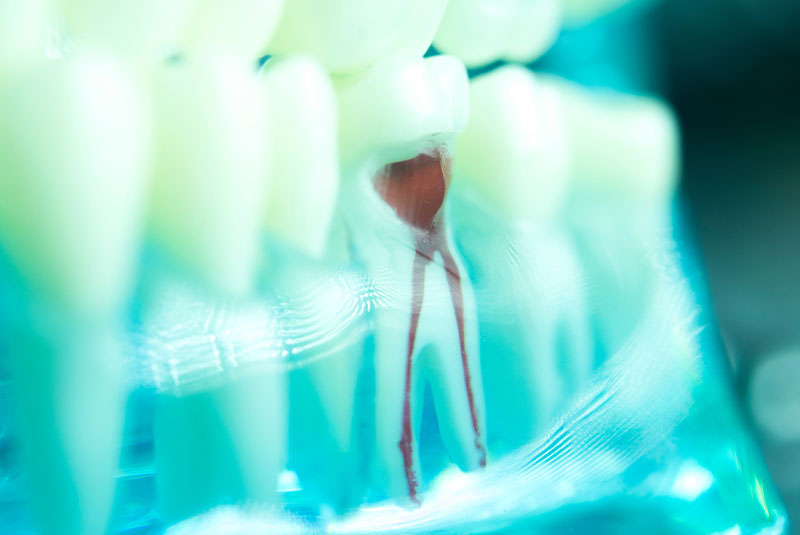 root canal model close up