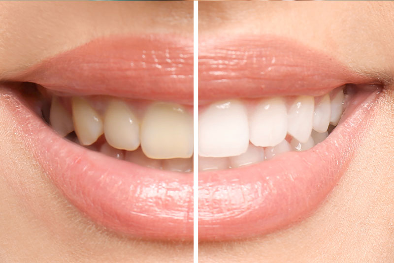 teeth whitening