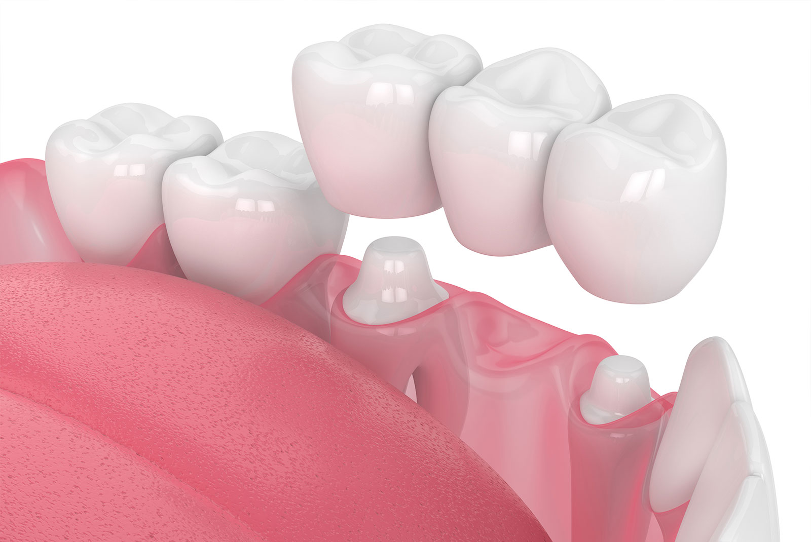 dental bridge