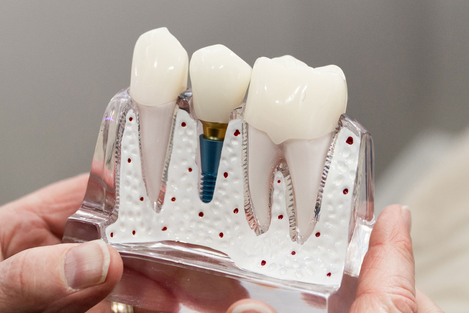 close up of dental implant model